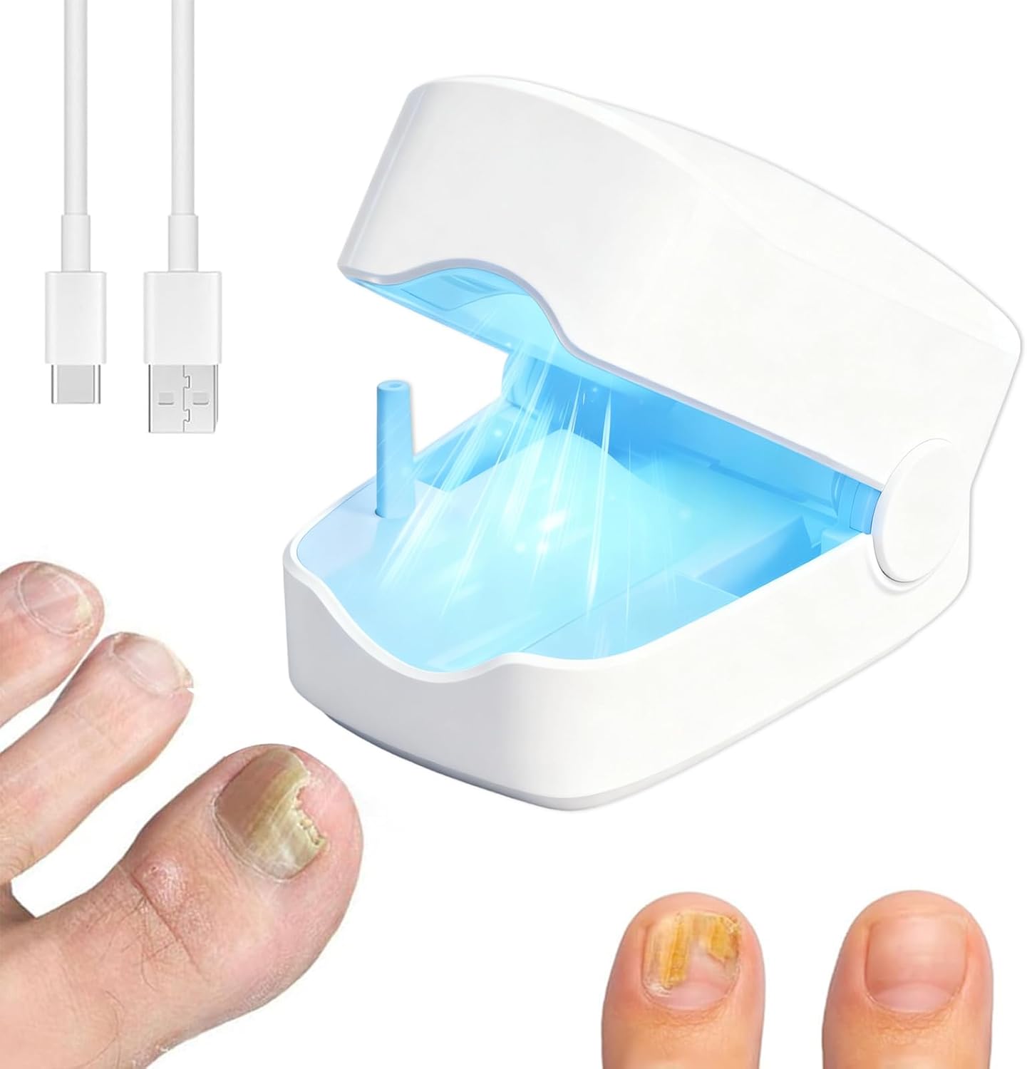 Dispositivo Láser para Hongos en las Uñas